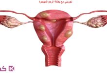 تجربتي مع بطانة الرحم المهاجرة