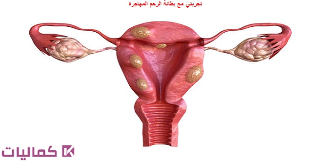 تجربتي مع بطانة الرحم المهاجرة